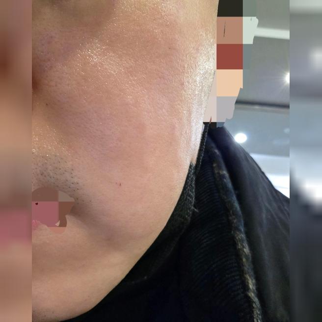수면 리쥬란 4cc 맞았는데 진짜 안 아파요!