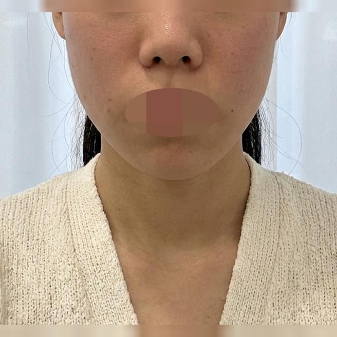 친구 소개로 방문, 병원 분위기부터 시술까지 다 만족이에요~