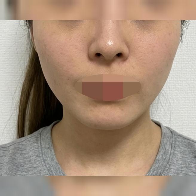 토닝 받았는데 다운타임 없이 피부톤 맑아지는 것 같아요 ㅎㅎ