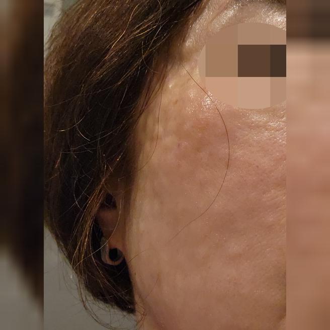 60대 후반, 수면 리쥬란으로 잔주름 관리 시작했어요ㅎㅎ