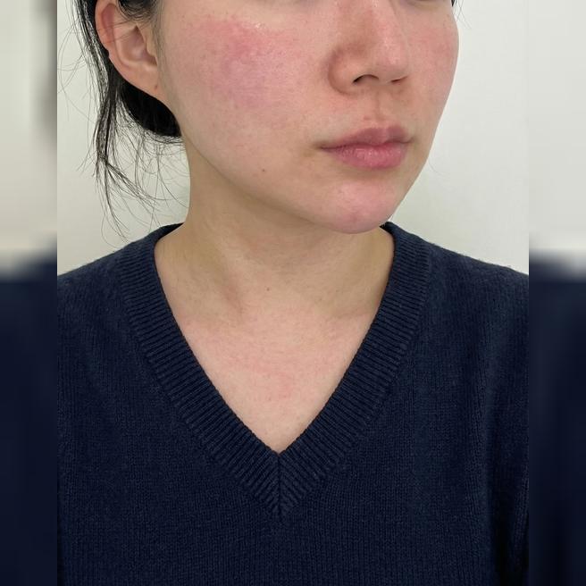 온다리프팅 받았는데 다운타임 없어서 바로 일상생활 가능!