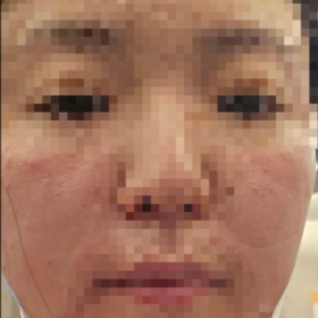 쥬베룩 시술 당일 후기! 앞으로의 피부 변화가 기대돼요