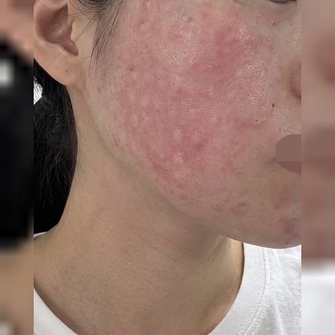 수면으로 편하게 받은 리쥬란, 시간 부담까지 없어서 좋았어요ㅎㅎ