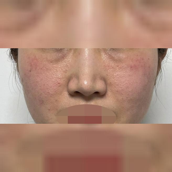 사진에도 보이는 화장 들뜸, 이제 끝내려고 리쥬란 시작했어요!1