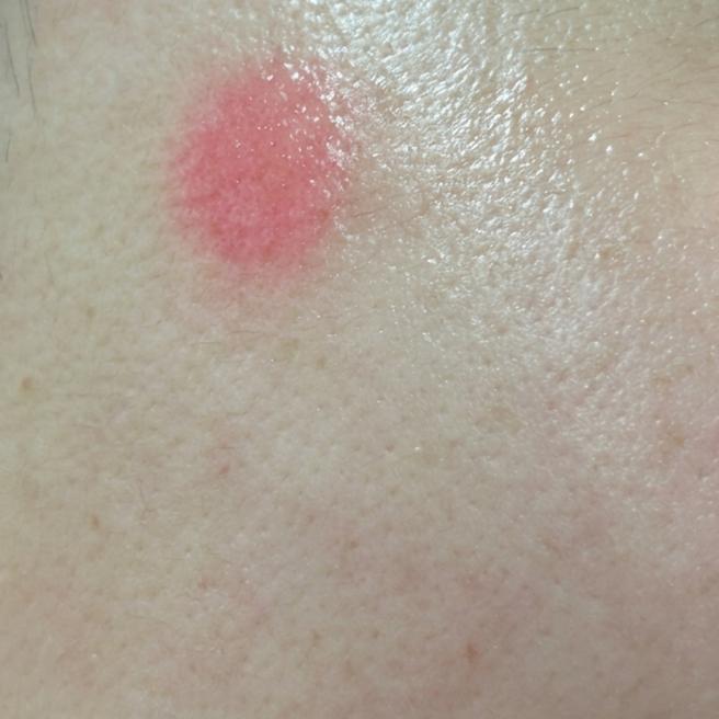 리팟레이저 3일차, 회복 과정 공유해요