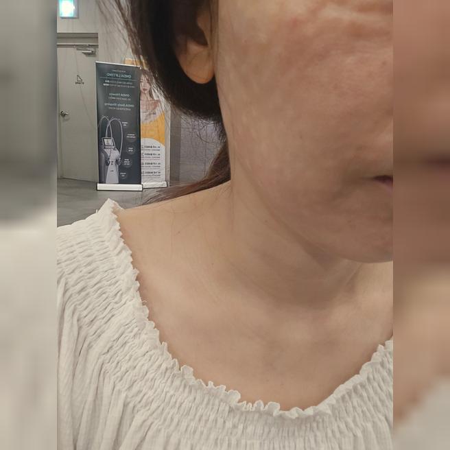 생기 없고 푸석해진 피부 고민으로 리쥬란 받으러 방문했어요!