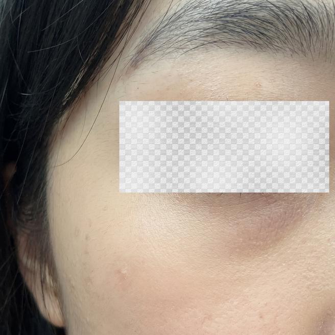 눈 주변 케어 필요하다 느껴져 서울아이성형외과에서 아이써마지 받은 1일차예요