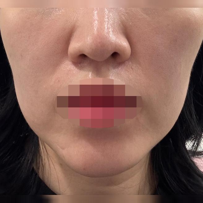 리쥬란 처음인데 꼼꼼하게 해주셔서 다음 달에도 하려고요 ㅎㅎ