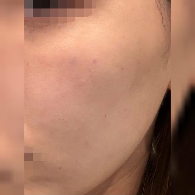 일본어 가능하고~안심하고 받은 것 같아요~리쥬란 4cc 받았는데 효과 기대돼요!