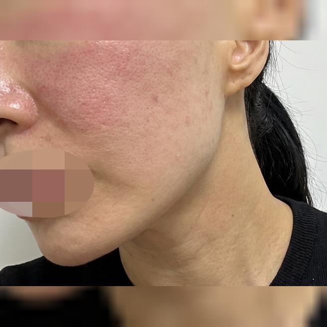 자외선으로 인한 피부 노화 고민, 두 시술 같이 받으니 시너지 좋아요!!