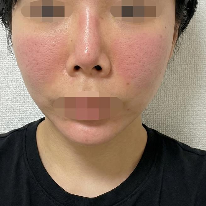 여드름 때문에 포텐자 받았는데 시술 끝나고 바로 좋아진 것 같아요ㅎㅎ