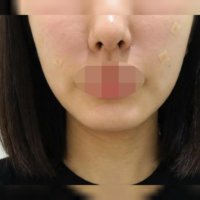 병원 분위기도 좋고 시술까지 세심해서 믿고 맡길 수 있었어요~