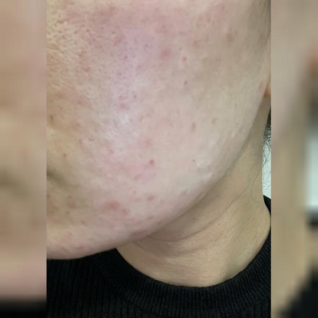 수면으로 통증 없이! 꼼꼼한 리쥬란 시술 만족스러웠어요~