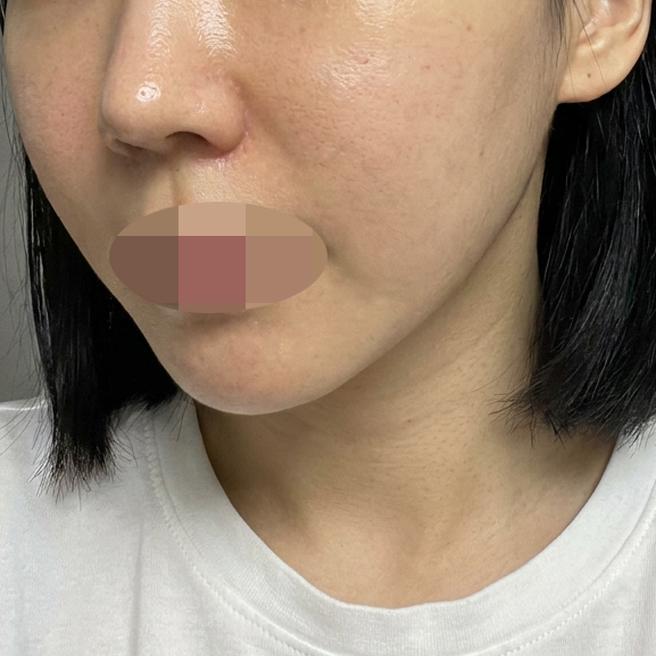양 볼 홍조랑 트러블 고민, 리쥬란으로 7일 차에 변화 느꼈어요~