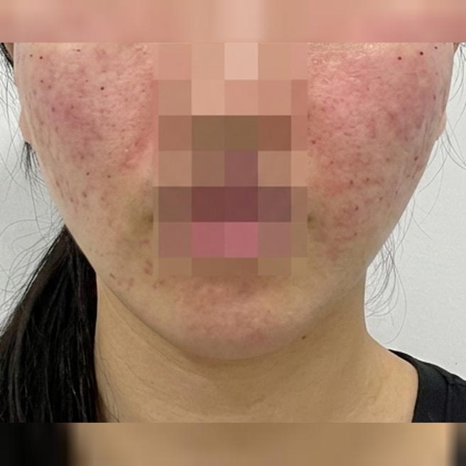 모공이랑 속건조, 수면으로 편하게 리쥬란 받고 왔어요~!