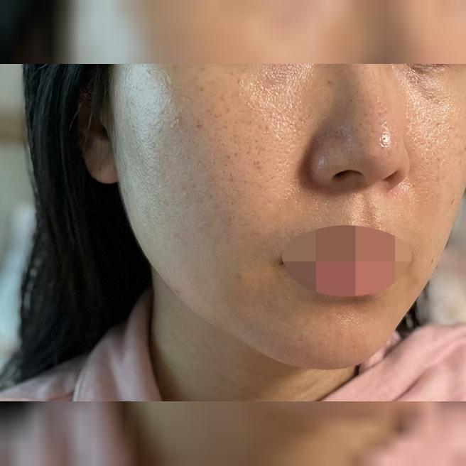 평소엔 리즈네만 받았는데 이번엔 스킨보톡스까지 같이 받아봤어요!!