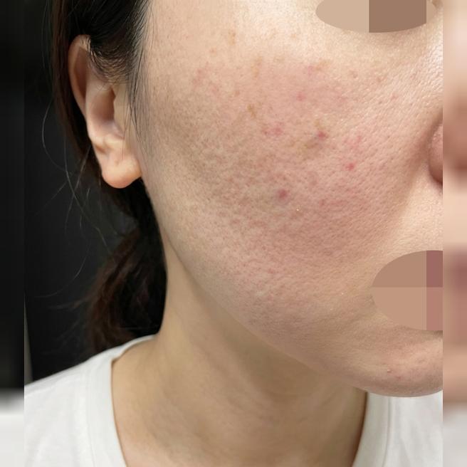 대기 시간도 짧고, 무엇보다 피부 건조해서 리쥬란 받았는데 꼼꼼해서 좋은 것 같아요ㅎㅎ