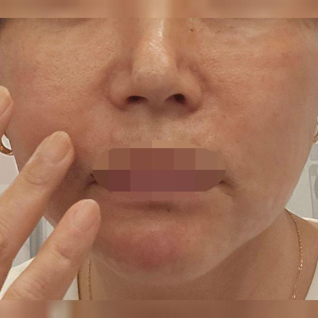 통증도 참을 만하고 편의성까지 좋은 리쥬란 받아봤어요