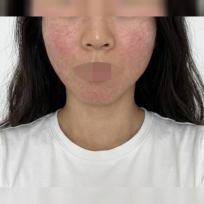첫 수면 리쥬란 걱정 많았는데, 친절하게 챙겨주셔서 안심했어요ㅎㅎ