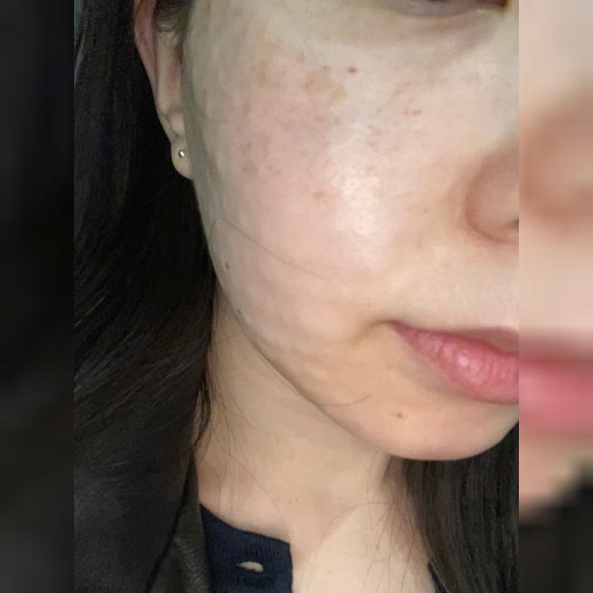 예비신부 피부 관리로 서울아이 리쥬란 선택한 2주차 후기예요