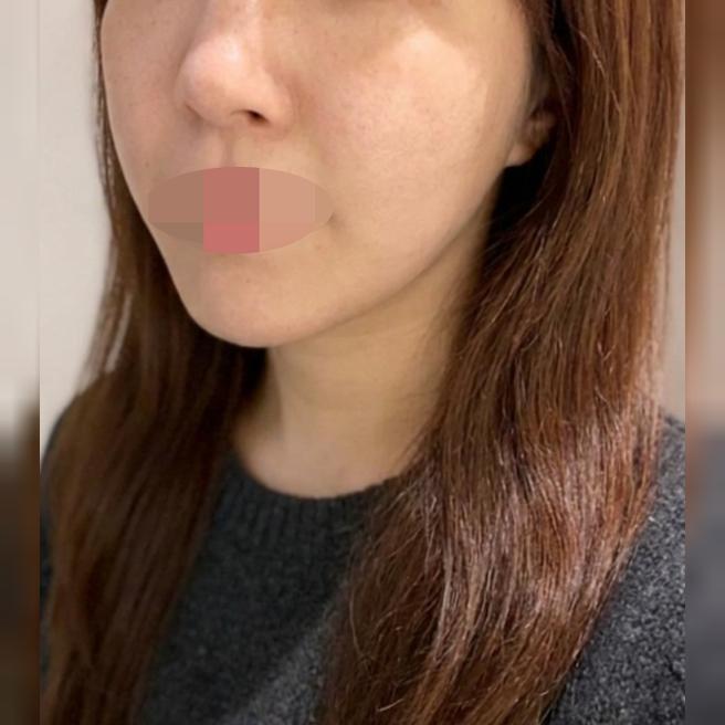 리프팅 처음인데 자세하게 상담해줘서 마음 놓였어요!