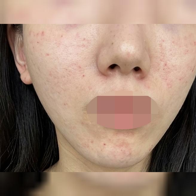 화장 들뜸 끊어내려고 받은 리쥬란, 결과 기대돼요!