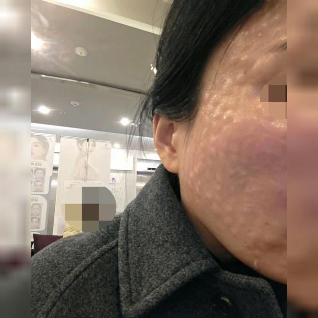 리쥬란 촘촘하게 잘 받고 왔어요 – 원장님 최고!