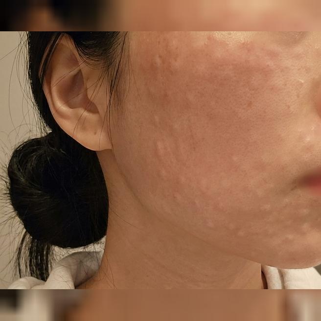 건조함과 리프팅 고민 한 번에 해결 할라고, 리쥬란 + 슈링크 조합으로 받아봤어요ㅎㅎ