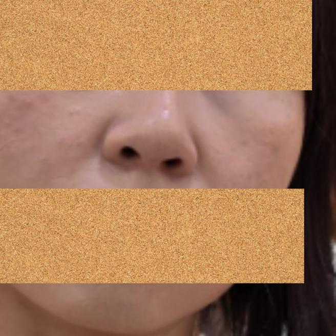 리쥬란 4일차, 엠보 가라앉고 이제부터 만족스러워요