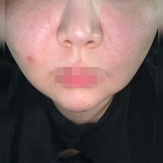 항상 푸석한 피부 고민으로 리쥬란 꾸준히 받고 있어요~!!