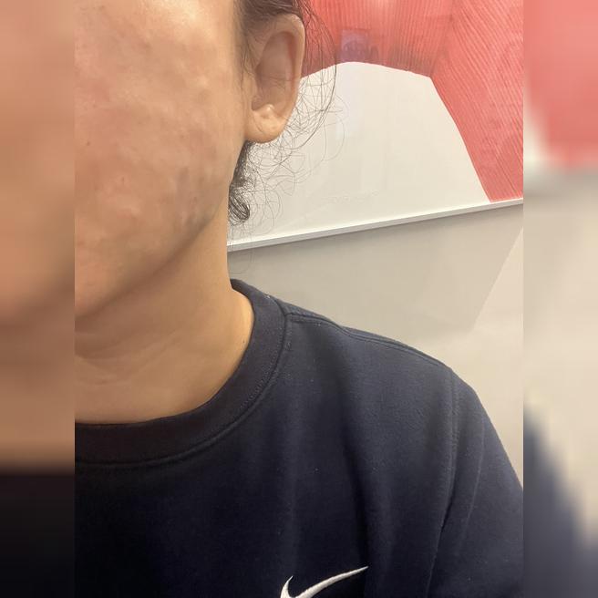 트러블이랑 피부장벽 고민으로 리쥬란 받으러 왔어요!