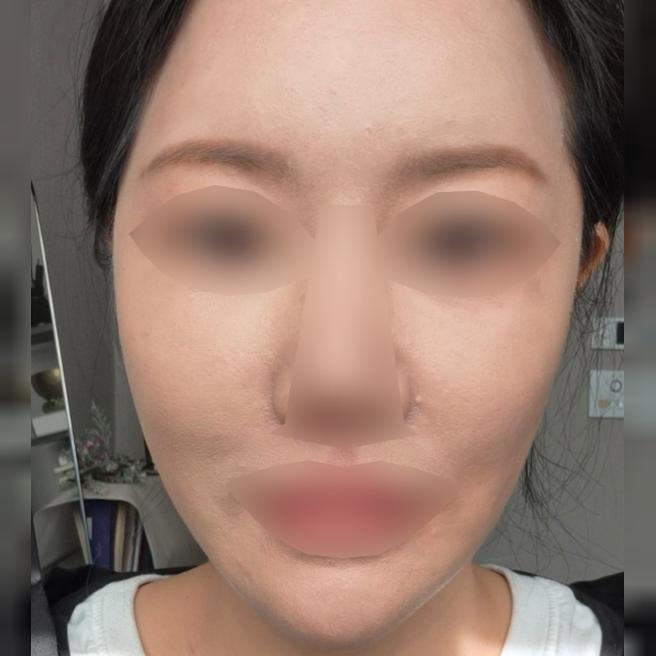 2주 만에 회복 끝! 다운타임 짧은 포텐자 재방문 후기