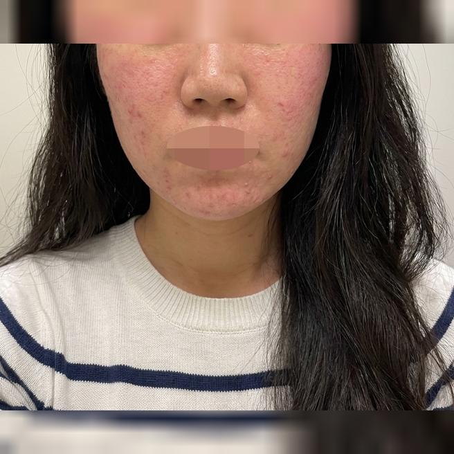 모공 관리 후기 보고 결정, 강남역에서 가까워 방문도 편했어요~