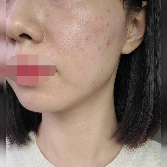 잊을만하면 또 생각나는 마성의 시술, 리쥬란 + 쥬베룩이에요ㅎㅎ