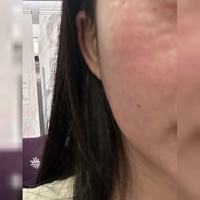 건조함이랑 리프팅 고민으로 슈링크+리쥬란 한번에 챙겼어요!!