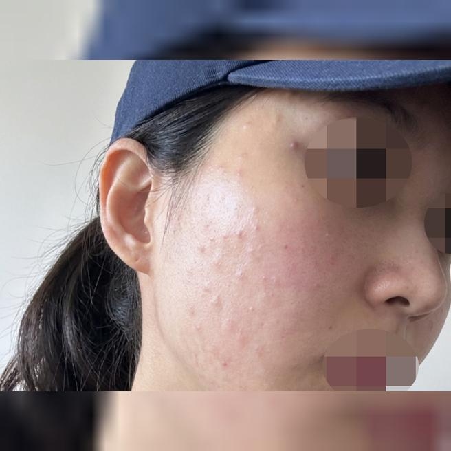 과한 권유 없는 솔직한 상담에 꼼꼼한 시술까지 만족이에요~ㅎㅎ