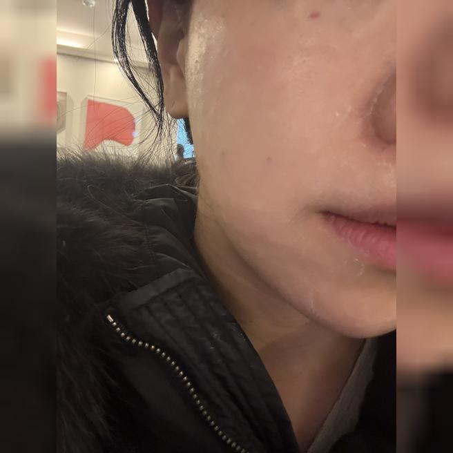 예식 전 피부관리로 왔는데 수면 리쥬란 너무 좋아요ㅎㅎ 재방문 예정!