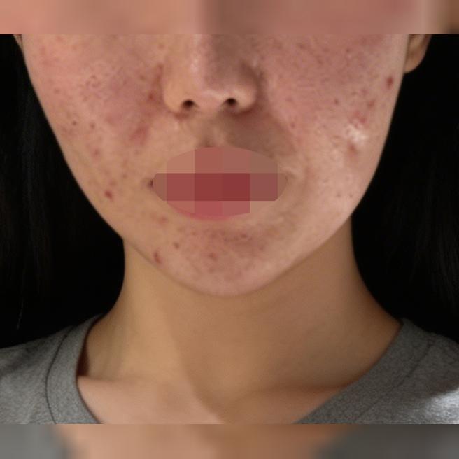 모공이랑 피부결 고민으로 역 근처 리쥬란 찾다가 방문했어요~!