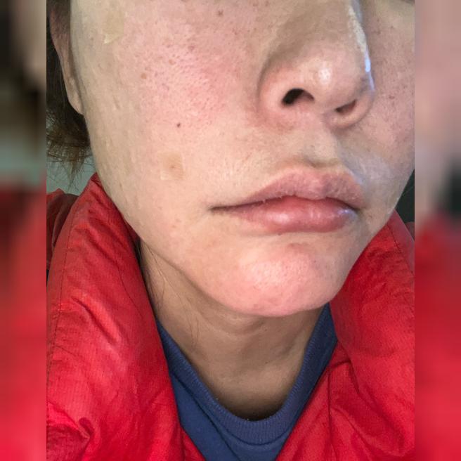 리쥬란 정품 확인 OK! 아침 일찍 대기 없이 쾌적하게 받고 왔어요