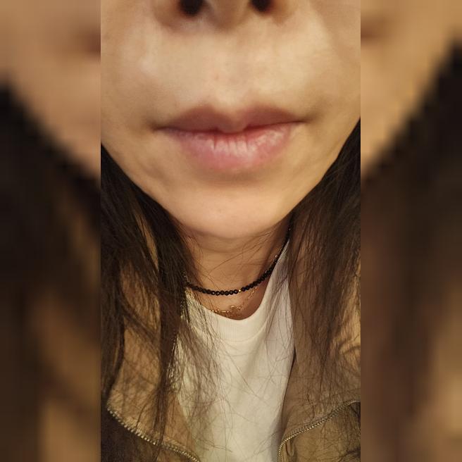 시술 4일차에 탄력이 달라졌어요 ! 서울아이 리쥬란힐러 찐후기