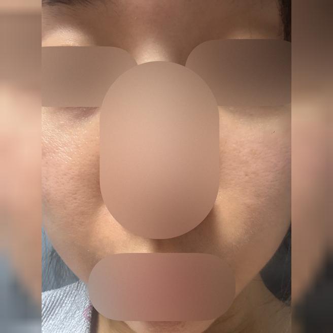 리쥬란 맞고 일주일 다 돼가는데 슬슬 기대되기 시작하네용!