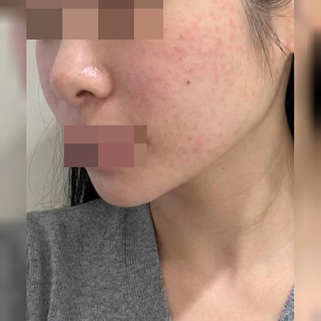수면 진행 덕분에 안 아프게! 멍도 적어서 바로 일상 복귀 가능해요~
