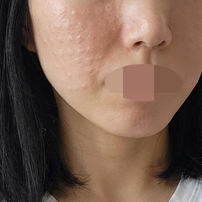 수면으로 진행해서 하나도 안 아프고 대만족으로 마무리했어요ㅎㅎ