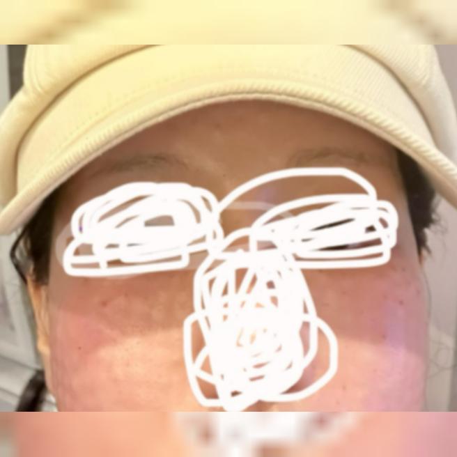 서울아이 리쥬란 당일 후기