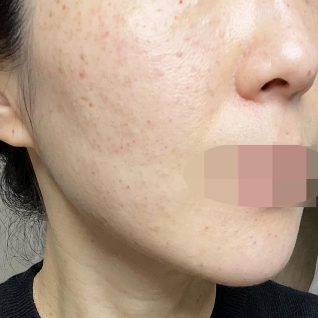 피부결이랑 흉터, 모공 고민으로 추천받아 리쥬베룩 받아봤어요~~