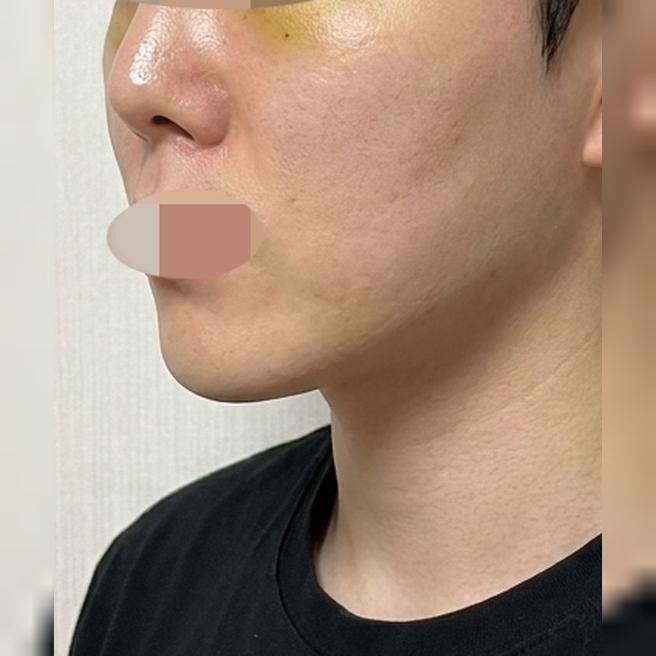 이해하기 쉽게 설명해주신 실리프팅, 결과도 너무 만족이에요~