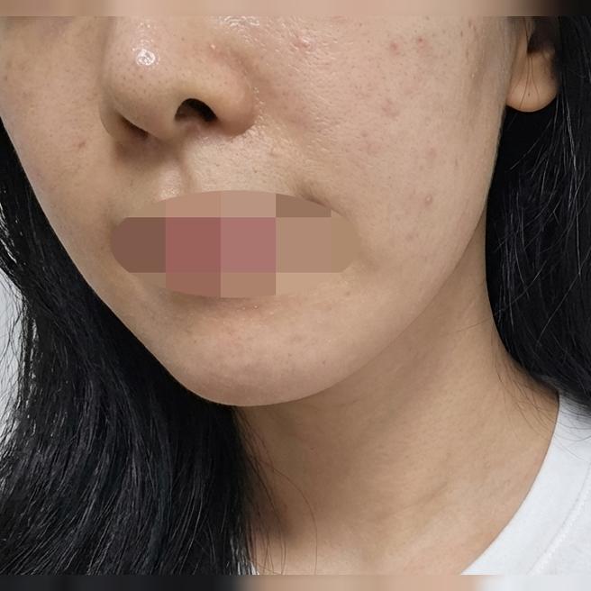만성 건조 피부 고민, 리쥬란+리쥬란아이로 한번에 챙겼어요!