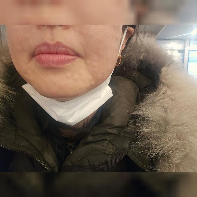 리쥬란 계속 받는 이유, 효과 좋아서 또 왔어요~