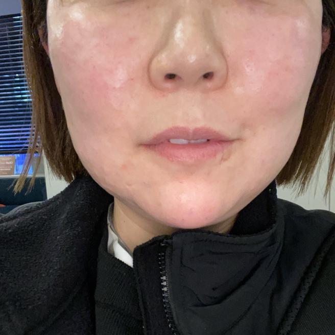 리쥬란 1일차 붉은기 있지만 효과 기대되는 중이에요^^