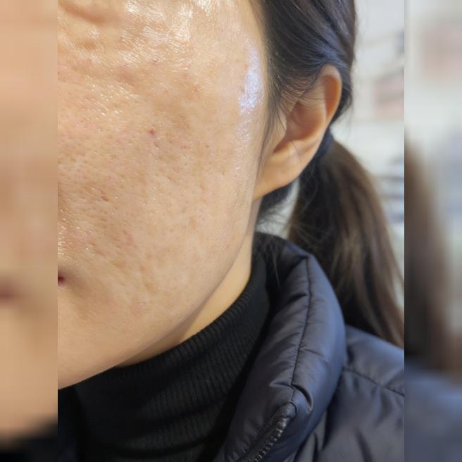 리쥬란 받았는데 30분이면 끝나고 효과 기대돼요~ㅎㅎ